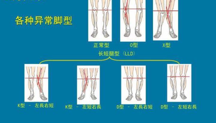 儿保科科普—各种异常脚型对宝宝生长发育的影响